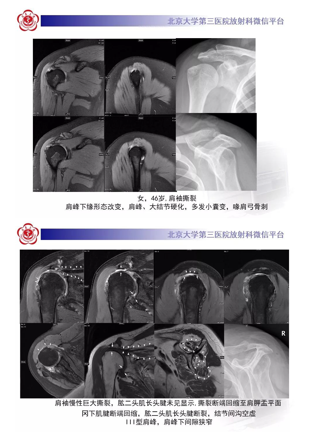 【PPT】肩袖疾病的X线检查及诊断-10