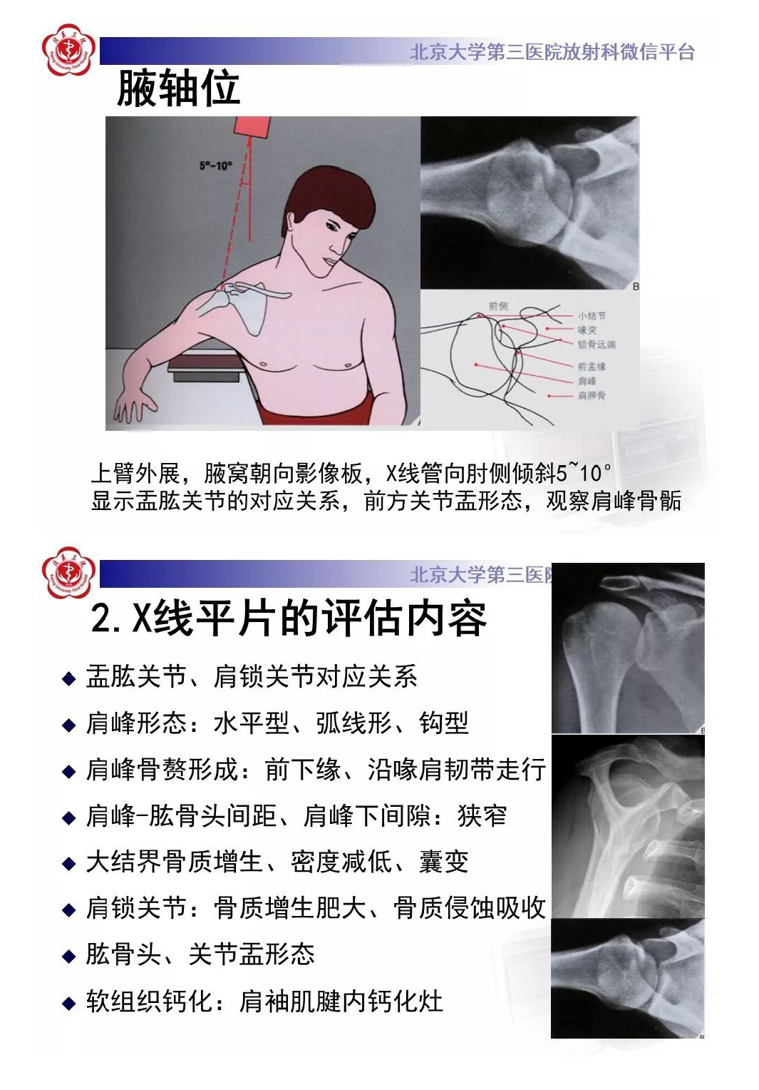 【PPT】肩袖疾病的X线检查及诊断-7