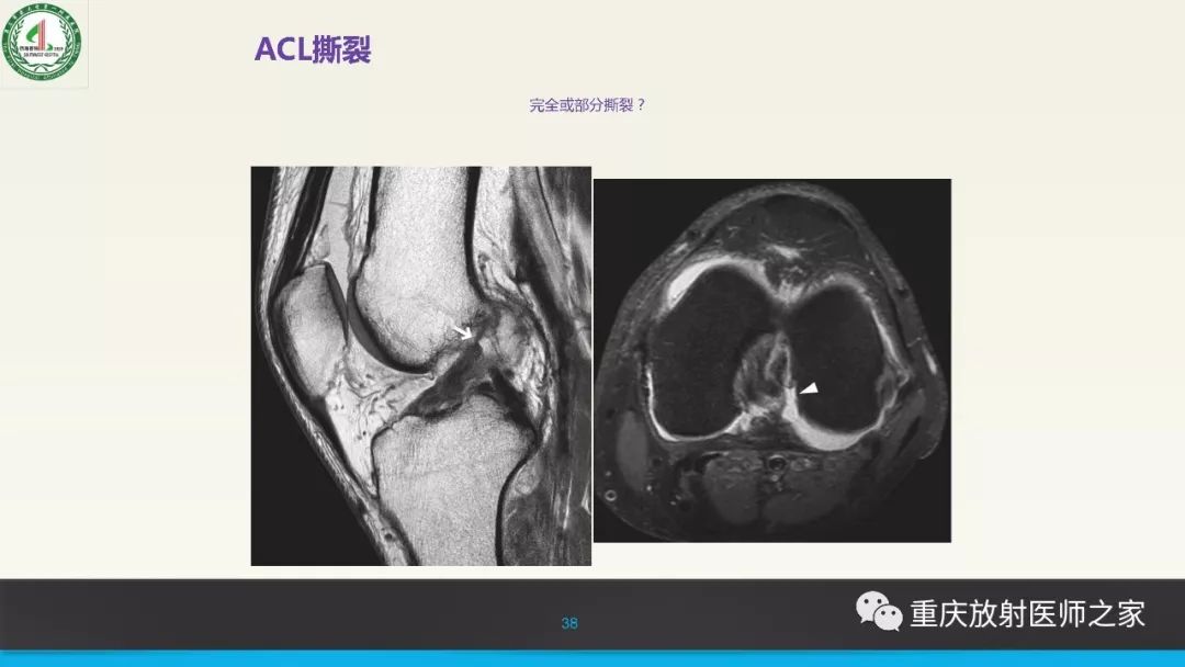 【PPT】膝关节韧带MRI诊断要点-38