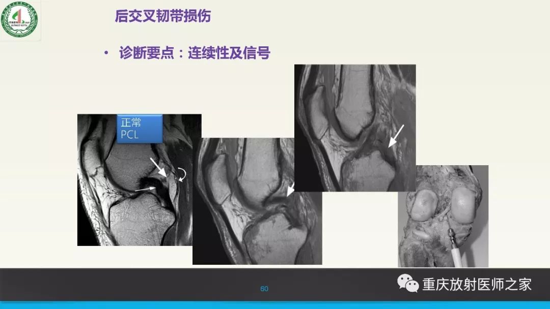 【PPT】膝关节韧带MRI诊断要点-60