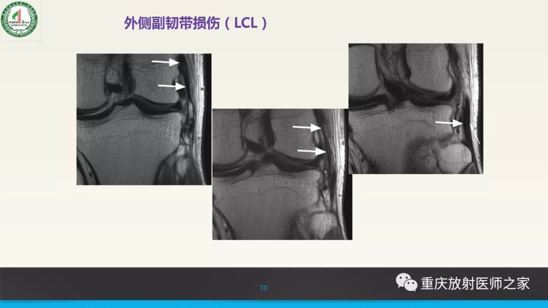 【PPT】膝关节韧带MRI诊断要点-70