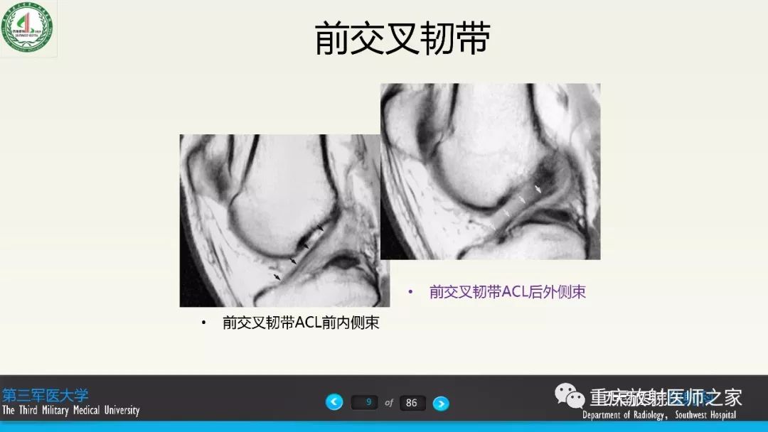 【PPT】膝关节韧带MRI诊断要点-9