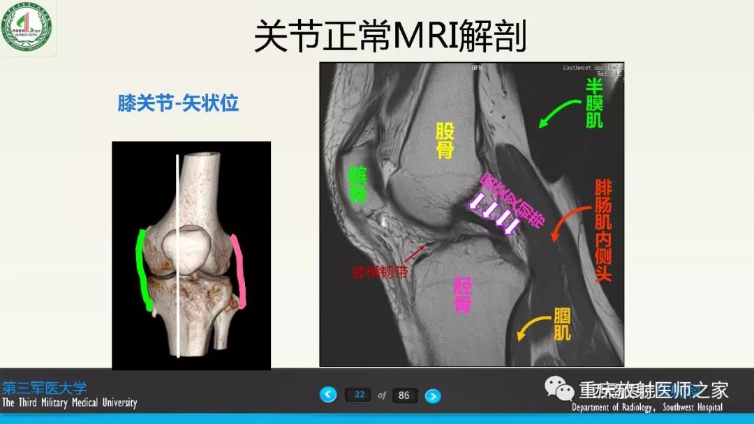 【PPT】膝关节韧带MRI诊断要点-22