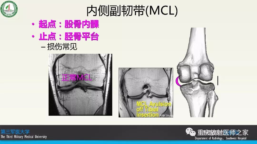 【PPT】膝关节韧带MRI诊断要点-13