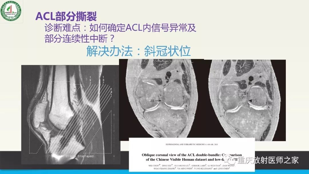 【PPT】膝关节韧带MRI诊断要点-51