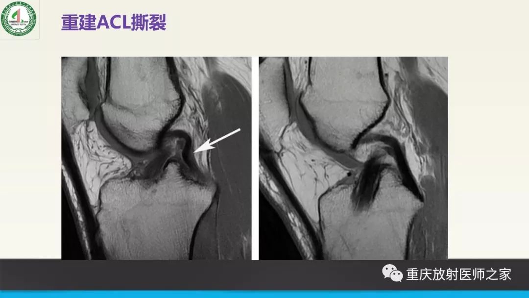 【PPT】膝关节韧带MRI诊断要点-81