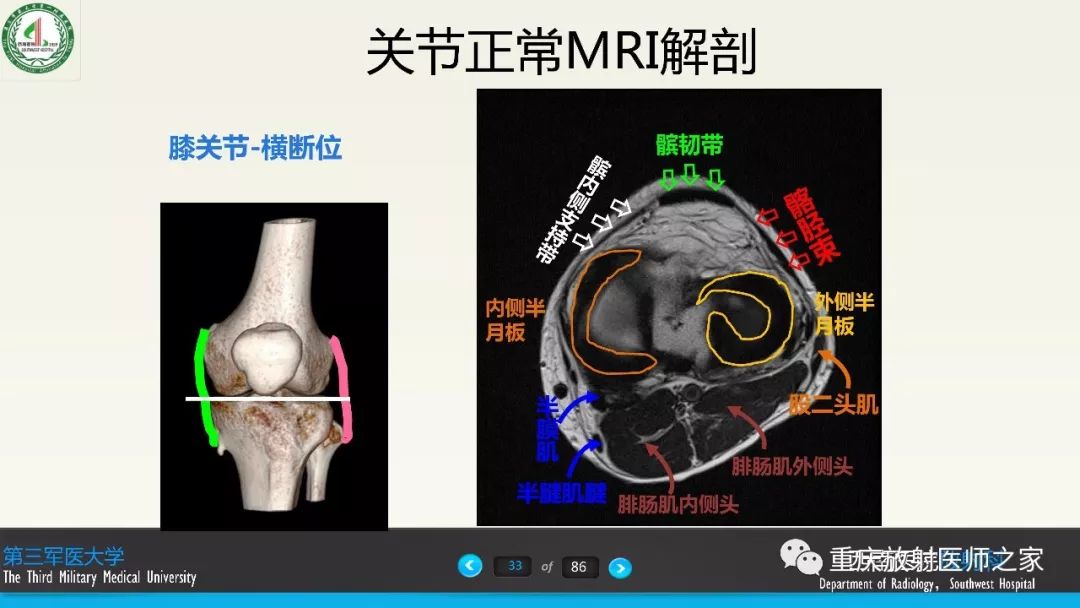 【PPT】膝关节韧带MRI诊断要点-33