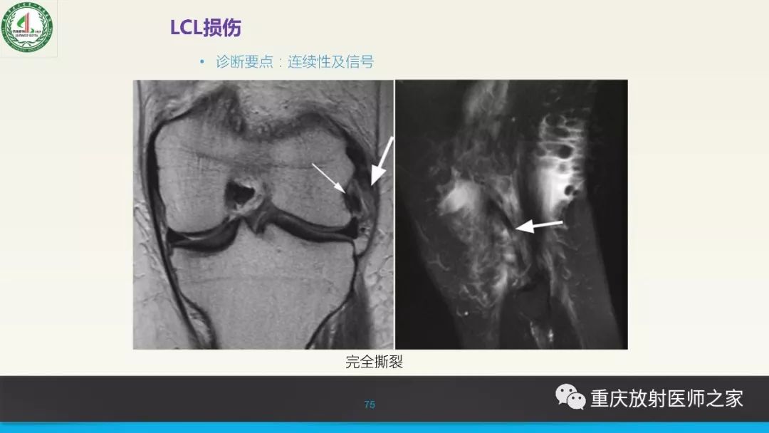 【PPT】膝关节韧带MRI诊断要点-75