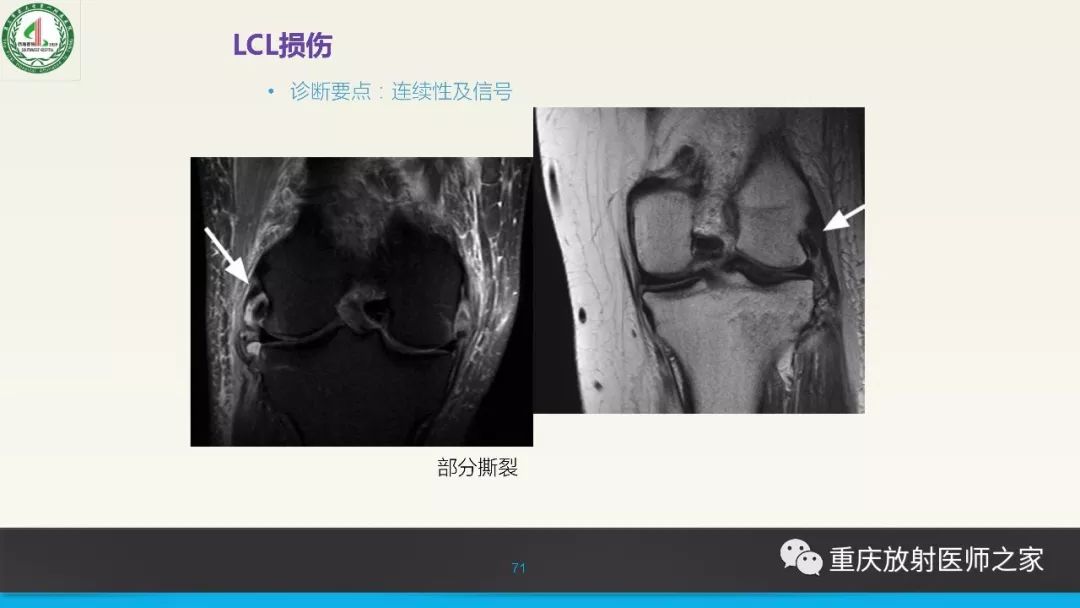 【PPT】膝关节韧带MRI诊断要点-71