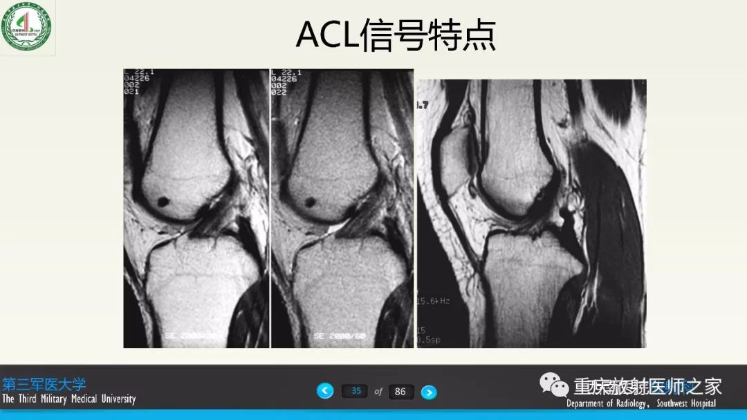【PPT】膝关节韧带MRI诊断要点-35