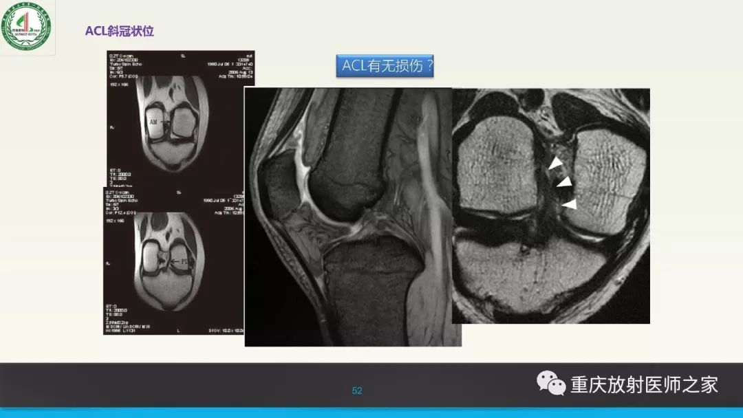 【PPT】膝关节韧带MRI诊断要点-52