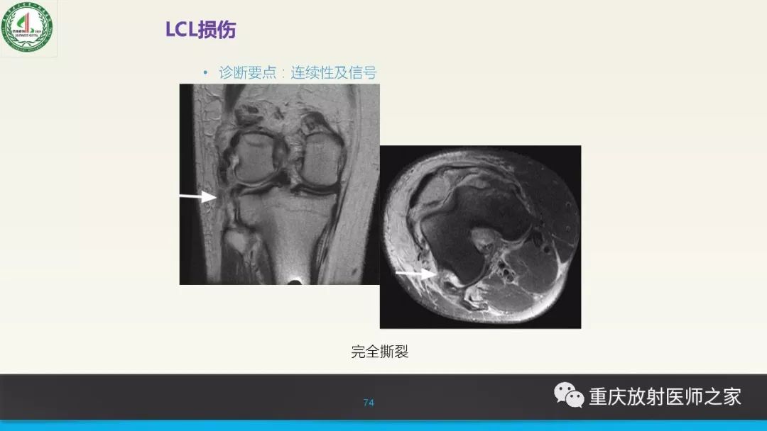 【PPT】膝关节韧带MRI诊断要点-74