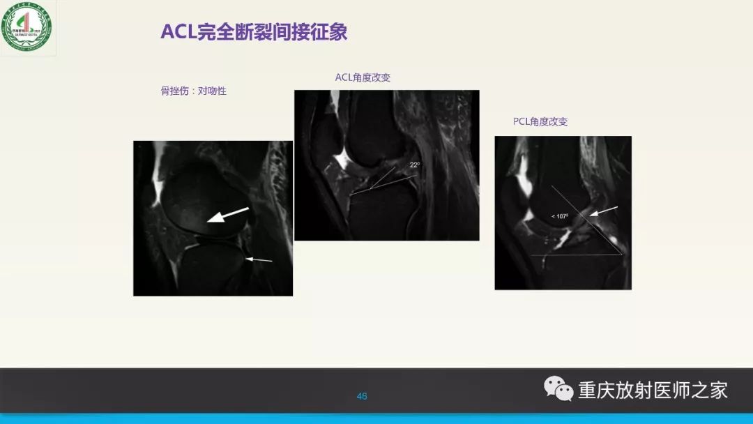 【PPT】膝关节韧带MRI诊断要点-46