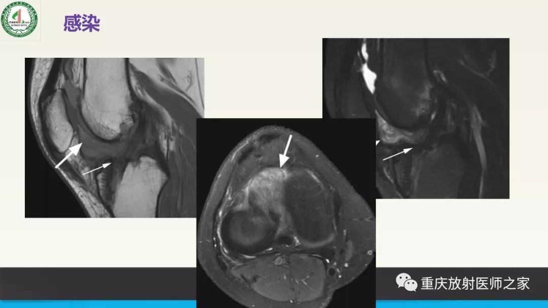 【PPT】膝关节韧带MRI诊断要点-84