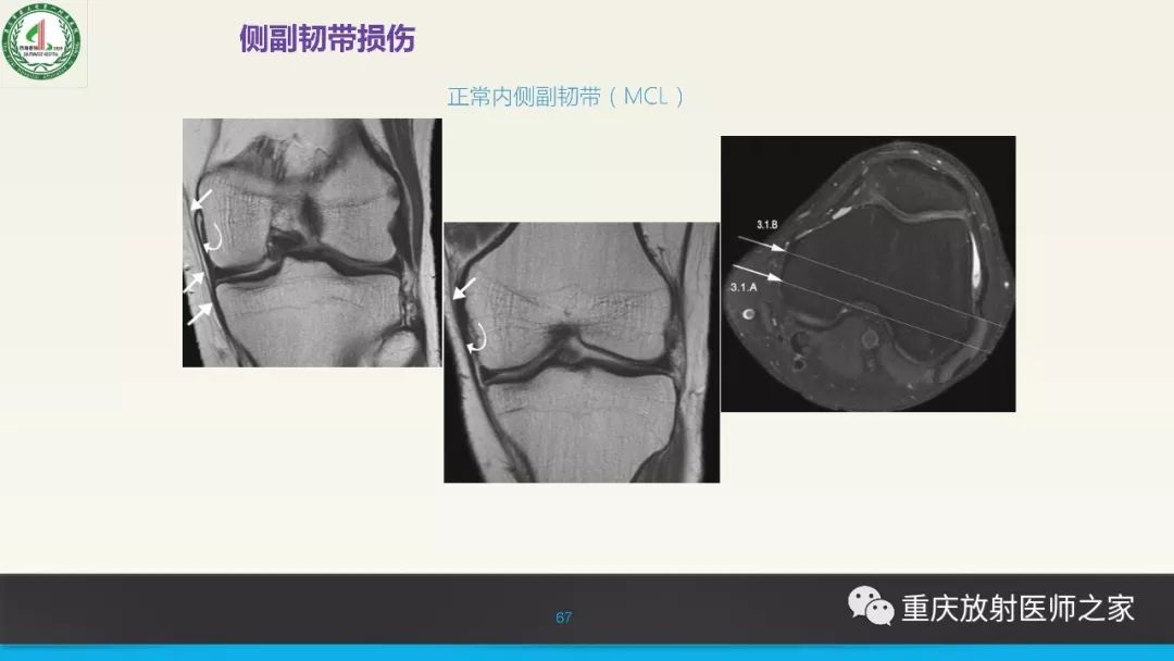 【PPT】膝关节韧带MRI诊断要点-67