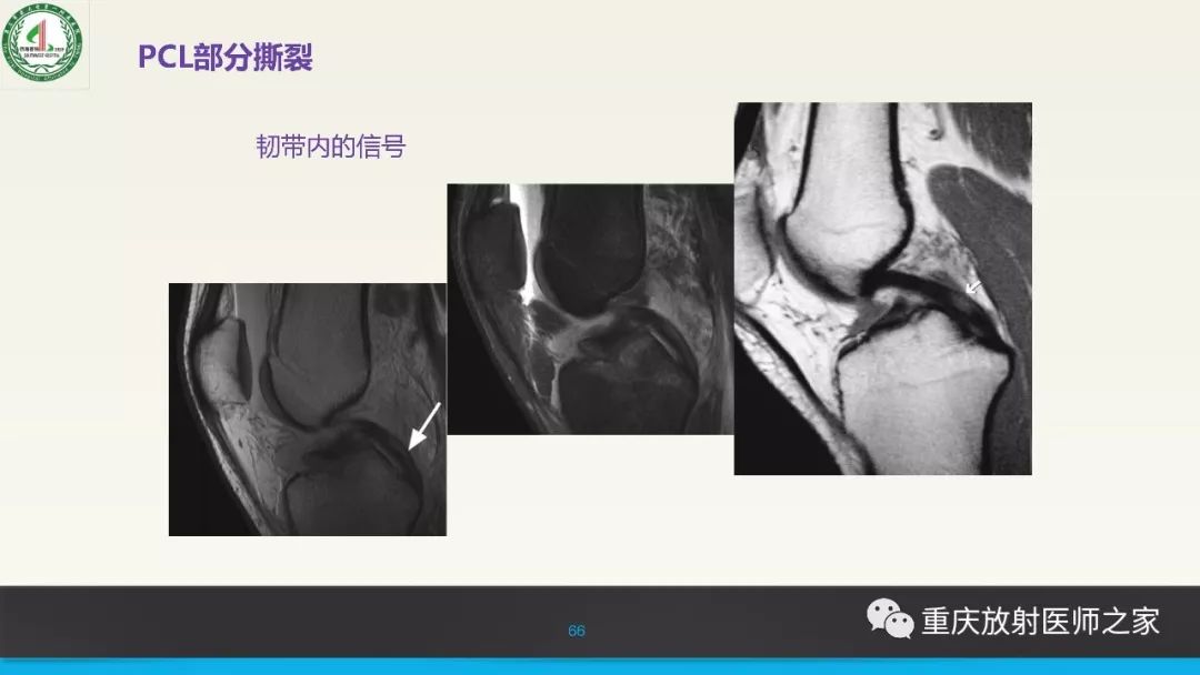 【PPT】膝关节韧带MRI诊断要点-66