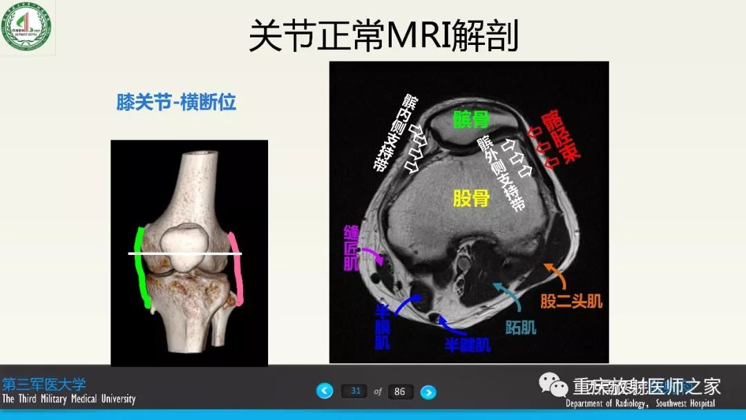 【PPT】膝关节韧带MRI诊断要点-31