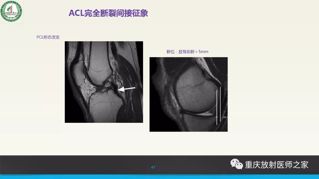 【PPT】膝关节韧带MRI诊断要点-47