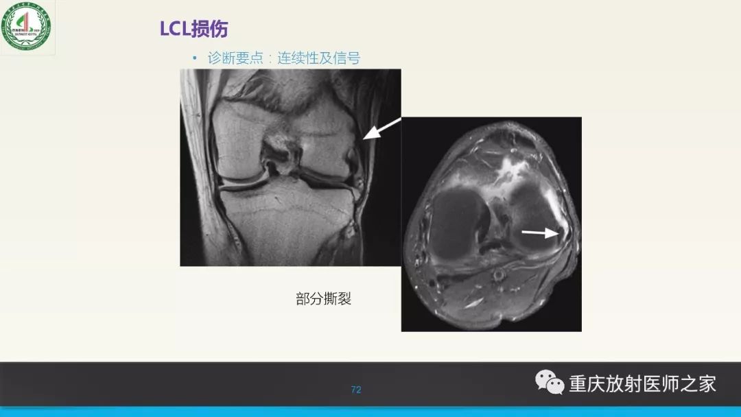 【PPT】膝关节韧带MRI诊断要点-72