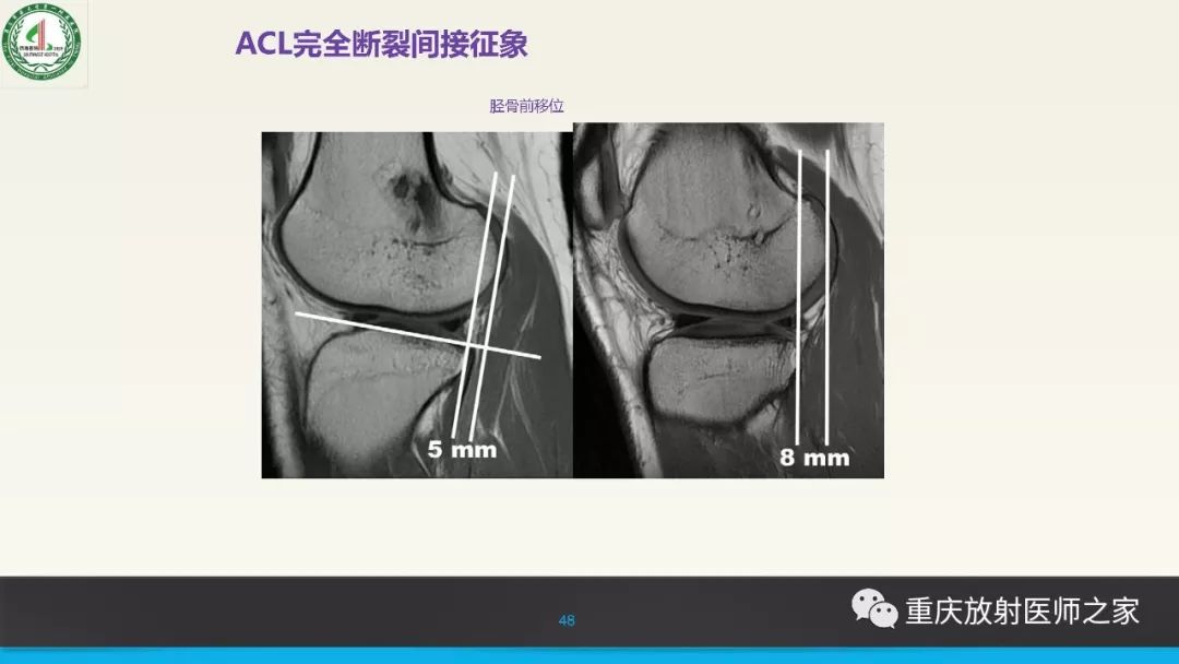 【PPT】膝关节韧带MRI诊断要点-48