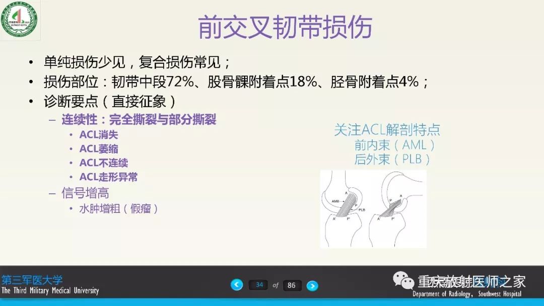 【PPT】膝关节韧带MRI诊断要点-34