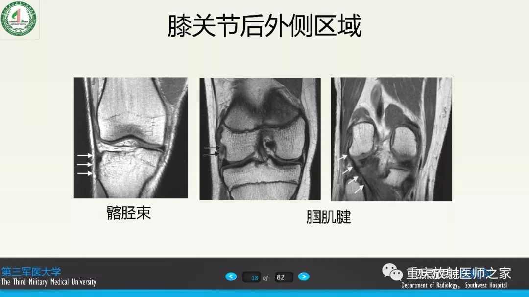 【PPT】膝关节韧带MRI诊断要点-18