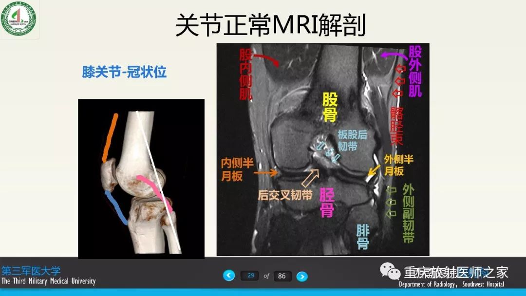 【PPT】膝关节韧带MRI诊断要点-29