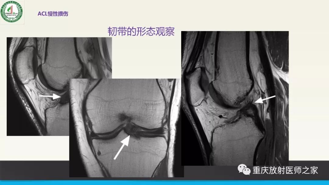 【PPT】膝关节韧带MRI诊断要点-56