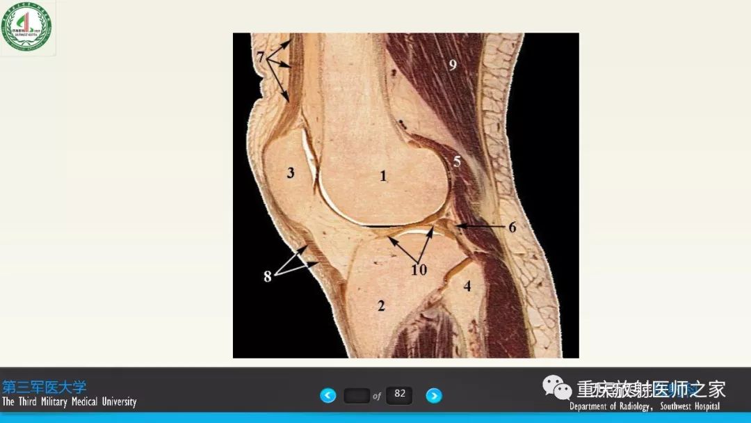 【PPT】膝关节韧带MRI诊断要点-5