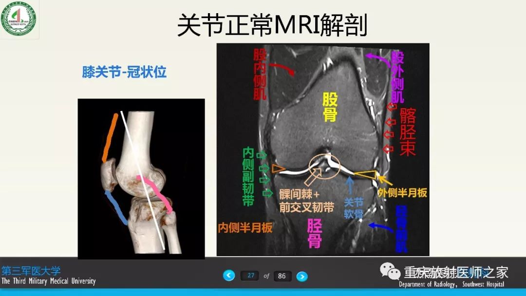 【PPT】膝关节韧带MRI诊断要点-27