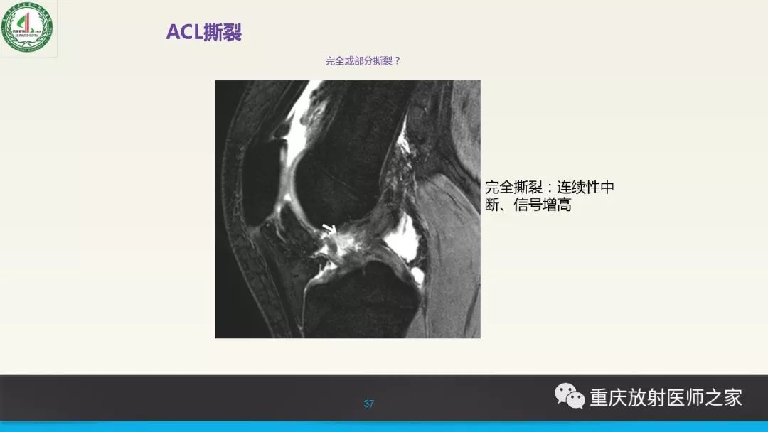【PPT】膝关节韧带MRI诊断要点-37