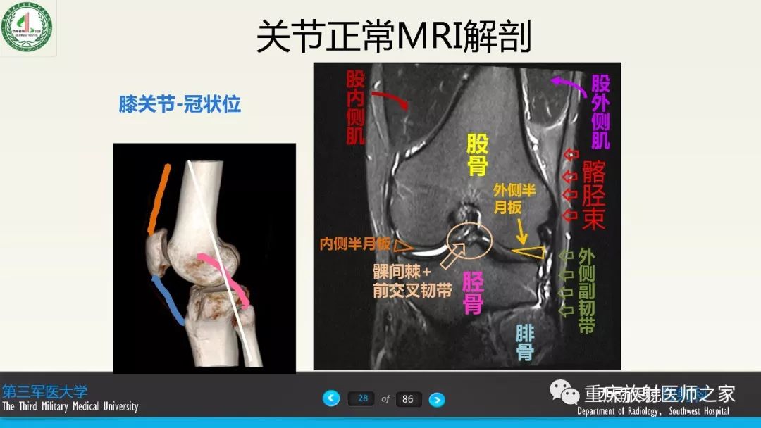 【PPT】膝关节韧带MRI诊断要点-28