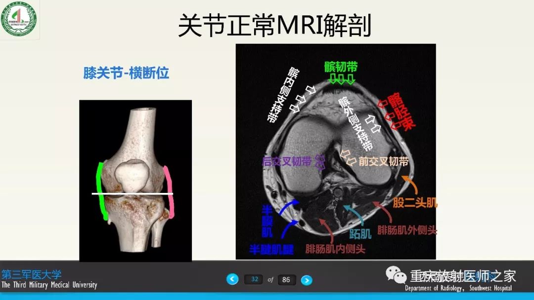 【PPT】膝关节韧带MRI诊断要点-32