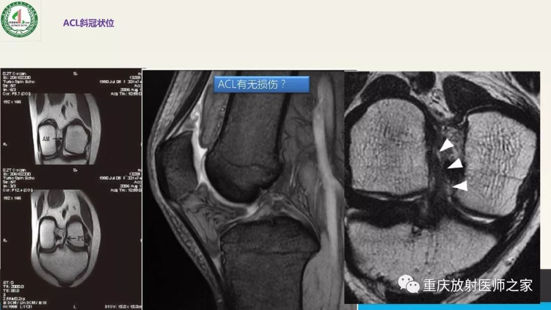 【PPT】膝关节韧带MRI诊断要点-54