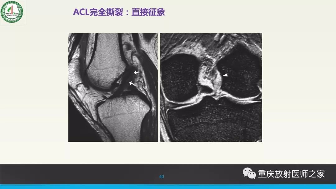 【PPT】膝关节韧带MRI诊断要点-40