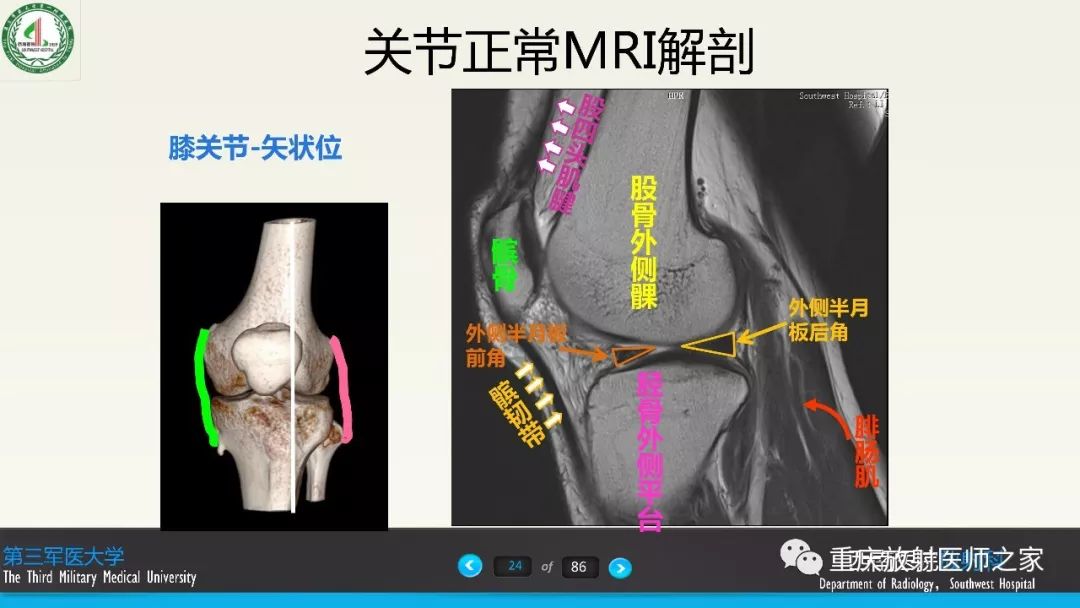 【PPT】膝关节韧带MRI诊断要点-24