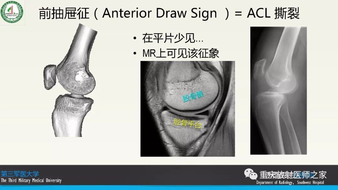 【PPT】膝关节韧带MRI诊断要点-42