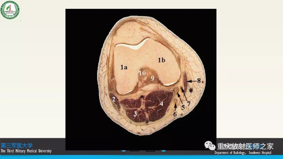 【PPT】膝关节韧带MRI诊断要点-15