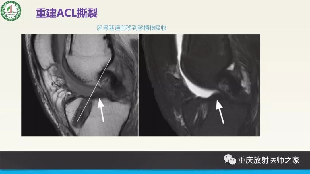 【PPT】膝关节韧带MRI诊断要点-80