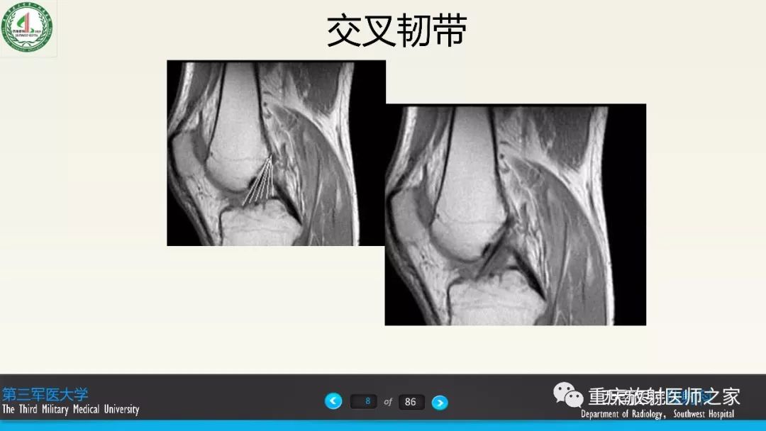 【PPT】膝关节韧带MRI诊断要点-8