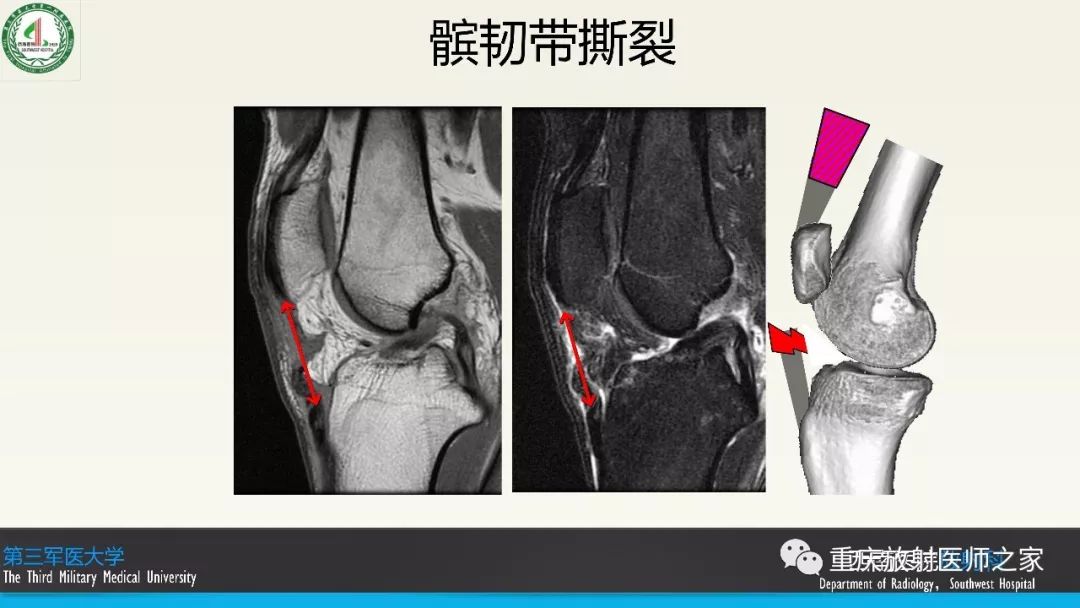 【PPT】膝关节韧带MRI诊断要点-77