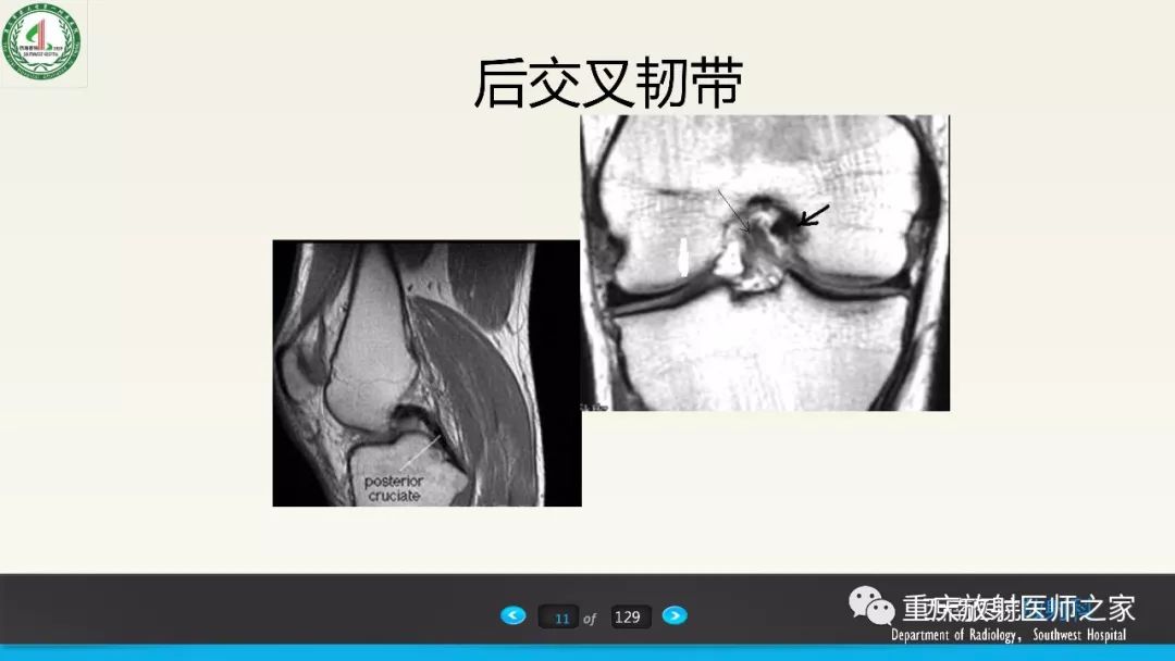 【PPT】膝关节韧带MRI诊断要点-11