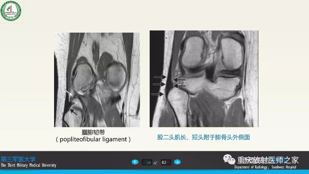 【PPT】膝关节韧带MRI诊断要点-19