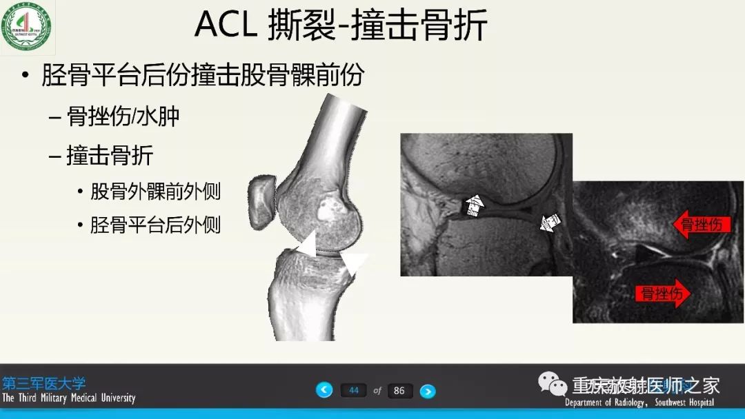 【PPT】膝关节韧带MRI诊断要点-44