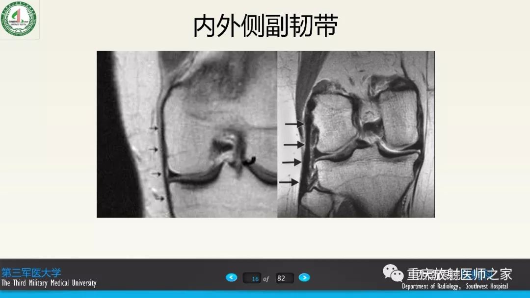 【PPT】膝关节韧带MRI诊断要点-16