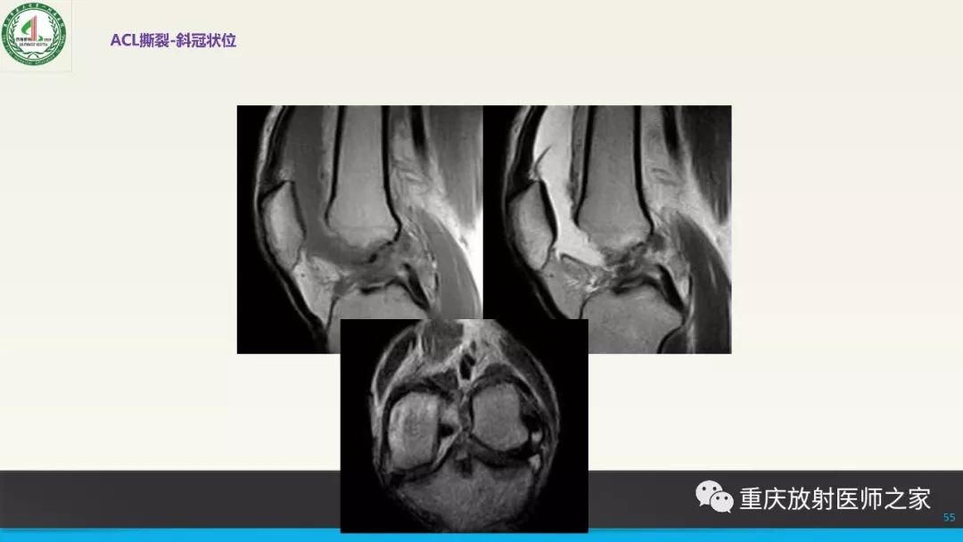 【PPT】膝关节韧带MRI诊断要点-55