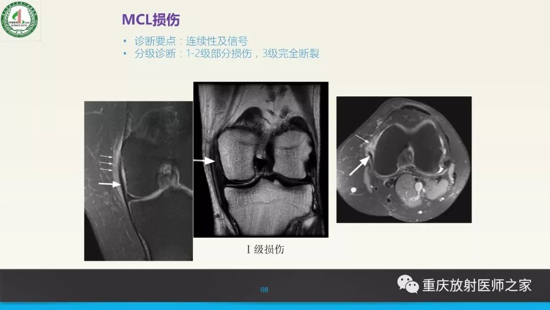 【PPT】膝关节韧带MRI诊断要点-68