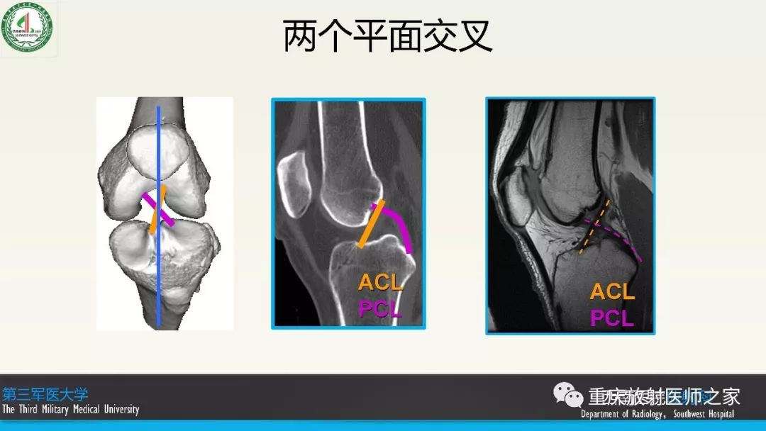 【PPT】膝关节韧带MRI诊断要点-3
