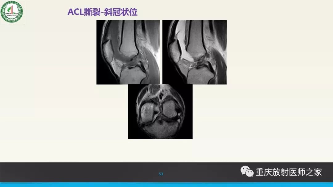 【PPT】膝关节韧带MRI诊断要点-53