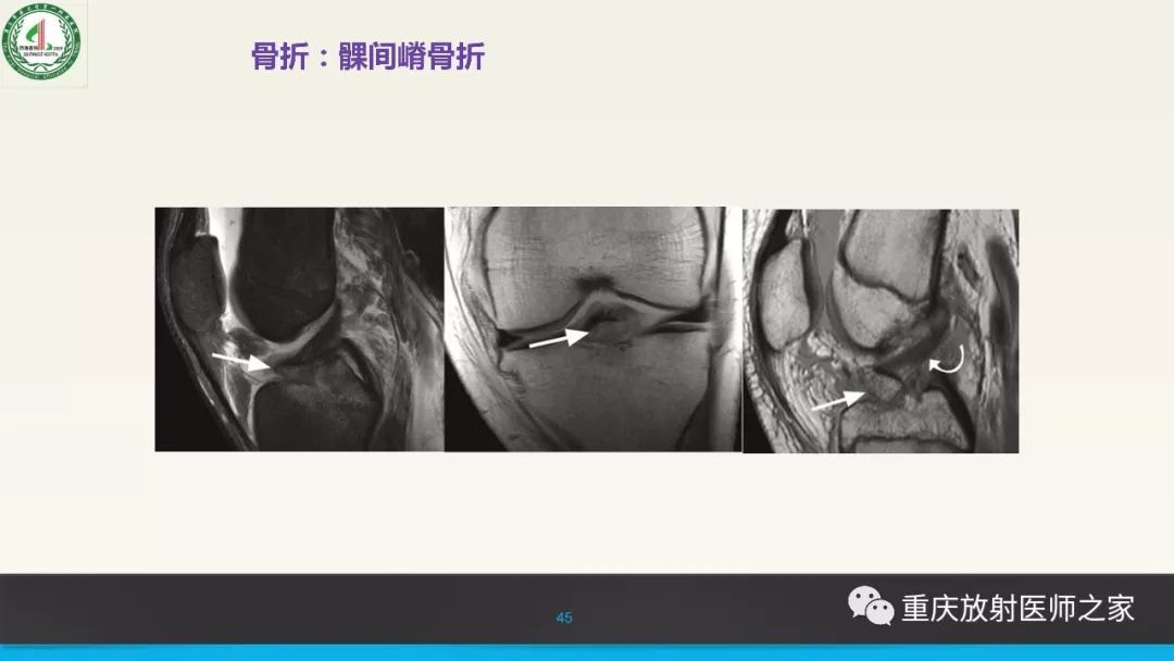 【PPT】膝关节韧带MRI诊断要点-45